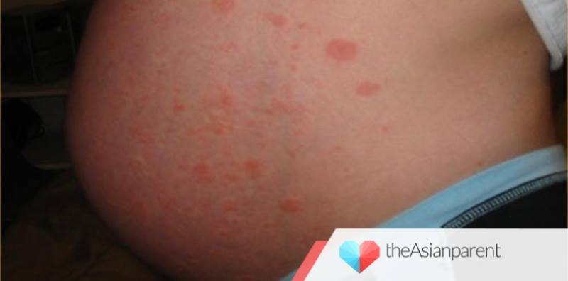 Ruam Gatal pada Perut di Trimester Akhir, Berbahayakah Bagi Janin? 