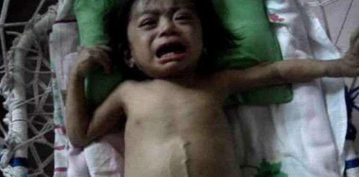 Kulit bayi kuning dan berat badannya turun? Waspadai Atresia Bilier!