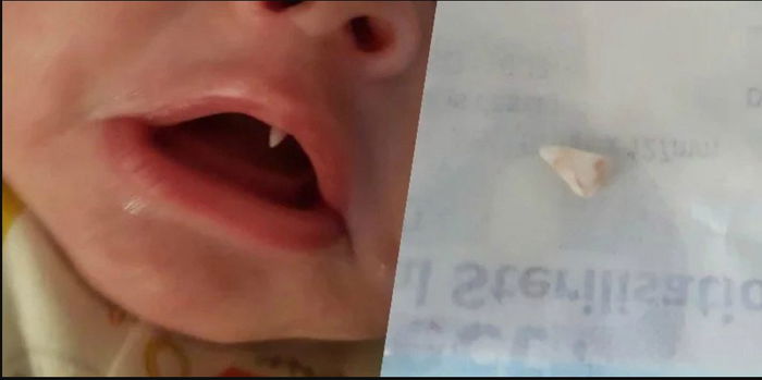 Aneh! Baru 2 bulan, bayi ini tumbuh gigi taring dalam semalam