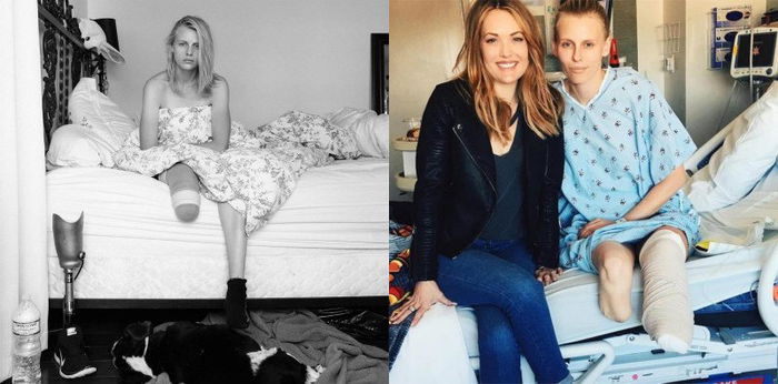 Keracunan saat memakai tampon, model ini harus kehilangan dua kakinya