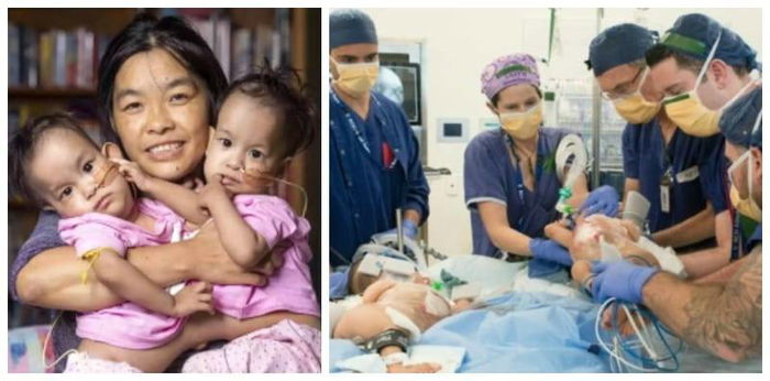 Sepasang balita kembar siam yang punya satu hati ini berhasil dipisahkan