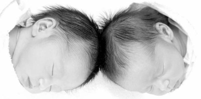 Bayi Lahir Kembar Siam, Apa Penyebabnya dan Bisakah Bertahan Hidup?