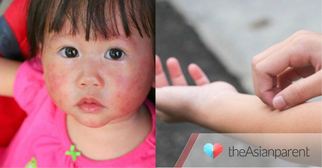 Anak alergi susu sapi, kenali gejala dan cara mengatasinya
