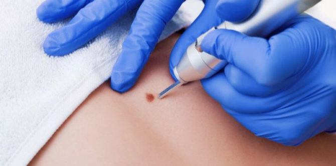 Bagaimana Cara Menghilangkan Tanda Lahir yang Mengganggu?