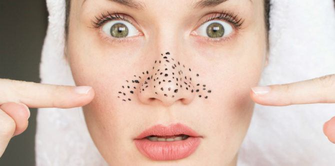 4 Cara ampuh hilangkan komedo membandel, Anda wajib coba!