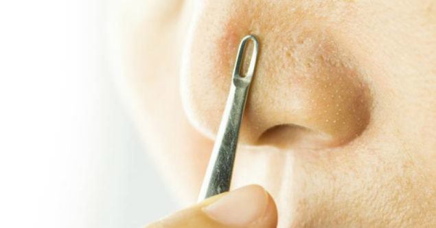 Kesal karena komedo menganggu penampilan? Simak 5 cara alami mengatasinya berikut ini