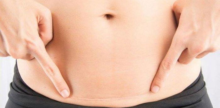 Lakukan 3 cara mudah ini agar luka bekas caesar cepat kering, Bunda!