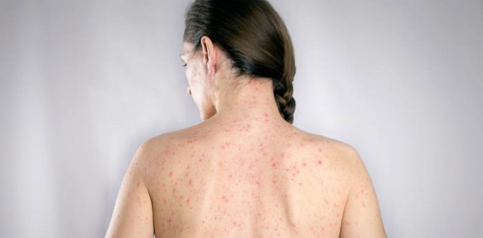 Bumil, Jangan Lupa Vaksin Rubella, Bila Tidak Ingin Bayi Lahir Cacat