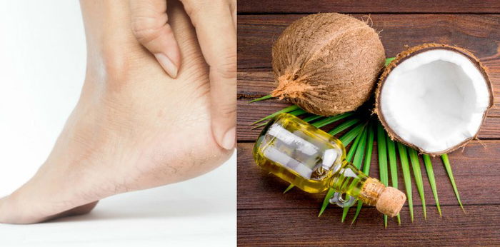 Tumit pecah bikin tak nyaman? Coba 5 bahan alami untuk mengatasinya berikut ini