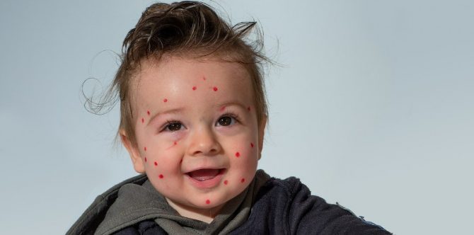 Bisakah Bayi Baru Lahir Tertular Cacar Air? Ini Penjelasannya, Parents