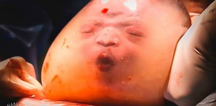 Langka, bayi ini lahir dengan terbungkus kantung ketuban yang masih utuh