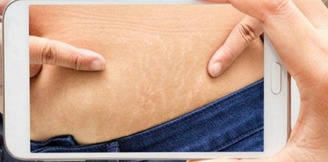 5 Bahan alami untuk menghilangkan stretchmark usai melahirkan, Bunda harus coba!