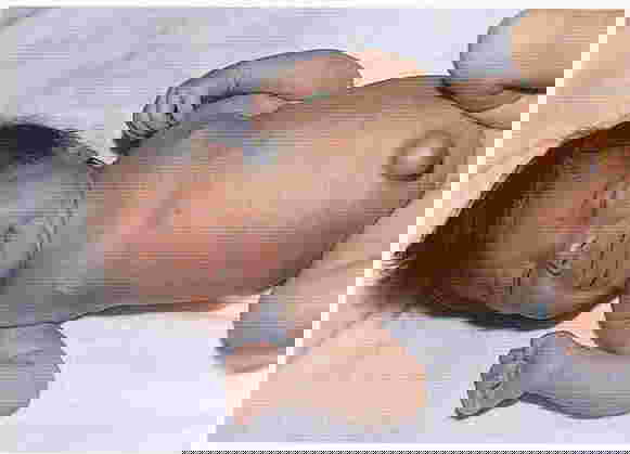 Hipotiroid pada bayi