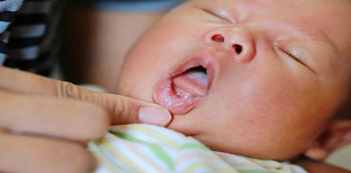 Bayi Susah Makan karena Sariawan? Obati dengan 5 Cara Alami Ini