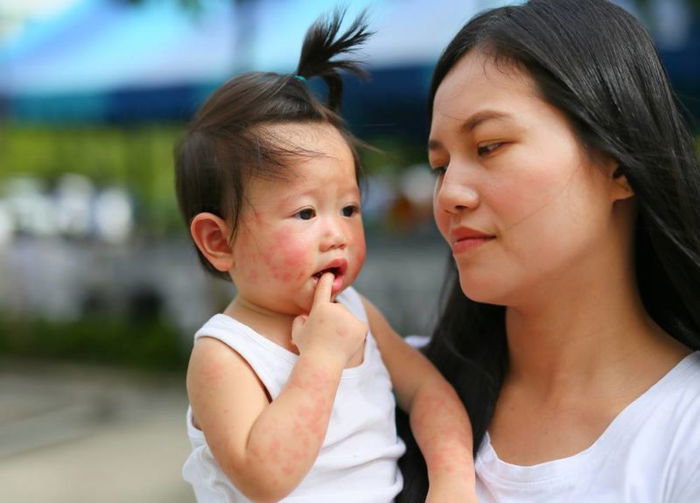 Pemilihan Nutrisi Tepat Cegah Dermatitis Atopik pada Si Kecil