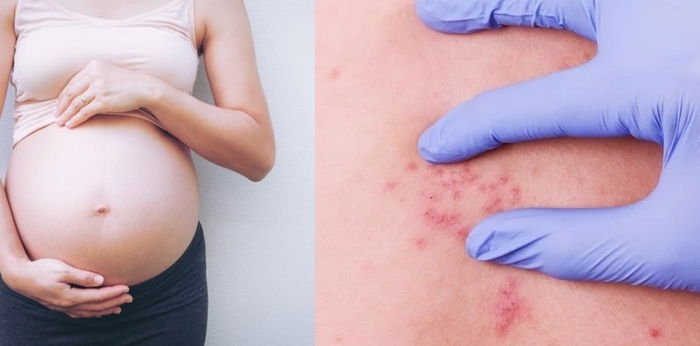 Herpes saat hamil sangat berbahaya bagi bayi, Bumil perlu waspada!