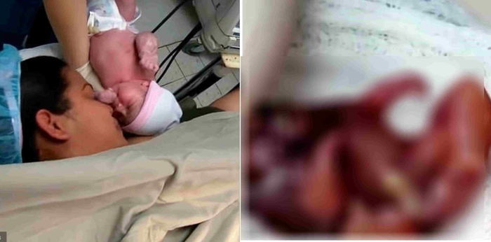 Langka! Bayi ini terlahir dengan 'saudara kembar' tanpa jantung dan otak