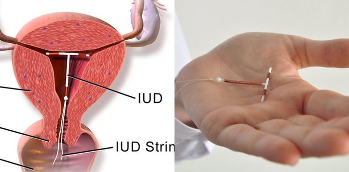 IUD Bisa Bergeser, Ini Penyebab dan Cara Menghadapinya!