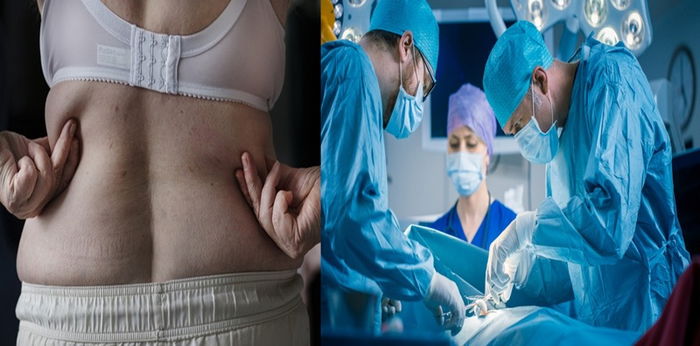 Mengenal Bedah Bariatrik, metode pangkas berat badan untuk pasien obesitas