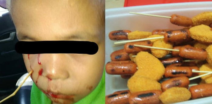 Tertancap tusuk sate ketika makan di mobil, wajah anak ini cedera parah