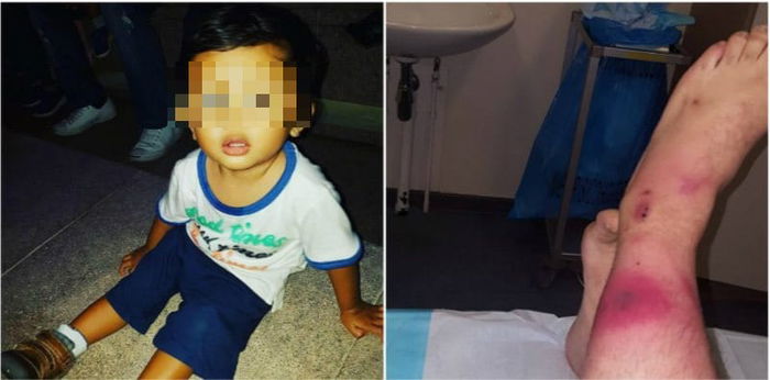 Akibat digigit serangga, kaki bocah lelaki ini nyaris diamputasi