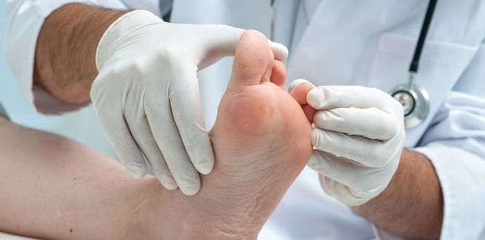 Jangan anggap sepele! Ini yang harus diwaspadai ketika terkena kutu air