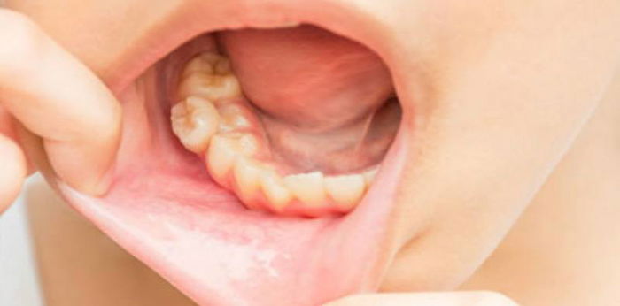 Mengenal maloklusi atau gigi berdesakan pada anak, kebiasaan buruk ini bisa menjadi pemicunya