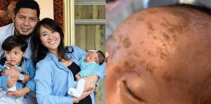 Anak kedua Chua Kotak alami dermatitis seboroik, berbahayakah?