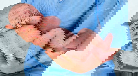 Herpes genital pada ibu hamil 1