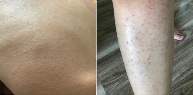 Gara-gara tabir surya, muncul bintik merah di tubuh anak ini