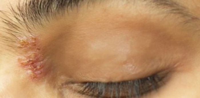 Bisa muncul di mata hingga sebabkan kebutaan, waspadai penyebab dan gejala herpes!