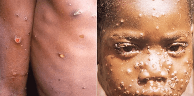 Viral penyakit cacar monyet masuk Indonesia, Kemenkes: "Itu Hoax!"