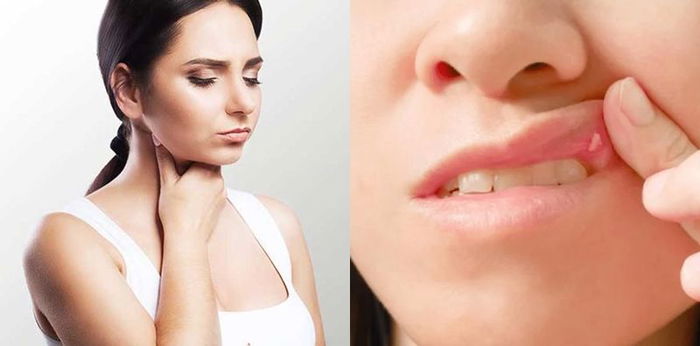 Sariawan tidak kunjung sembuh? Waspada gejala kanker tenggorokan!