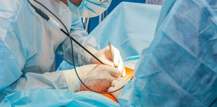 Video laparoskopi, prosedur operasi untuk menyukseskan program hamil
