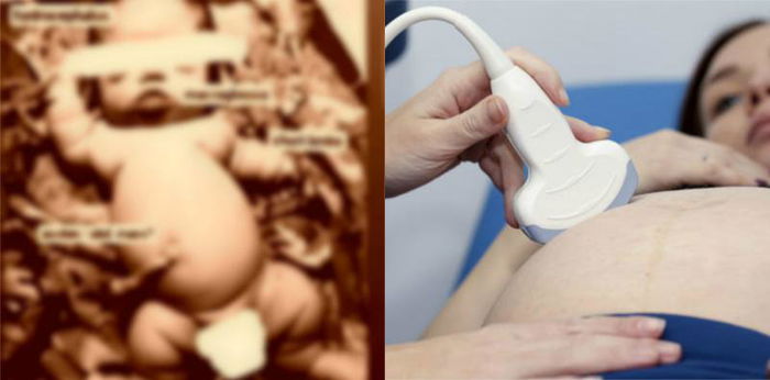 Tak pernah USG saat hamil, bayi sungsang lahir meninggal, ini tanggapan dokter