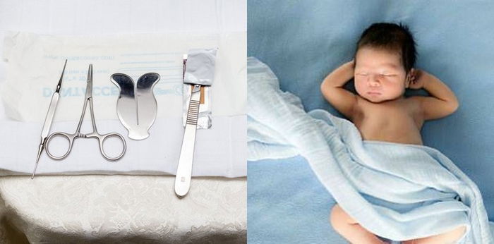 Sunat Bayi: Manfaat, Risiko dan Cara Perawatannya