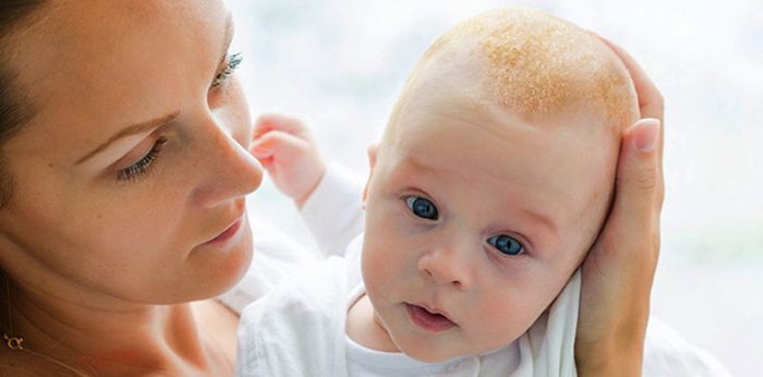 Kenali Cradle Cap pada Bayi, Gejala hingga Cara Mengatasinya!