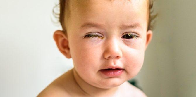 5 Obat Sakit Mata untuk Bayi yang Bisa Dilakukan di Rumah