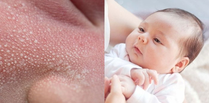 Kenali Milia pada Bayi, Bintik Putih yang Muncul di Wajah Si Kecil