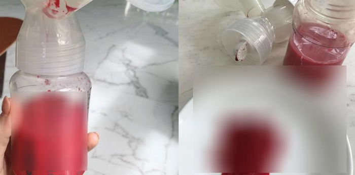 "Pembuluh darah di payudaraku pecah saat memompa ASI," pengalaman seorang ibu