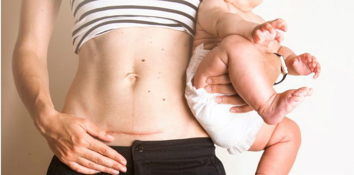 3 Pengalaman ibu yang merasakan persalinan caesar tanpa rasa sakit