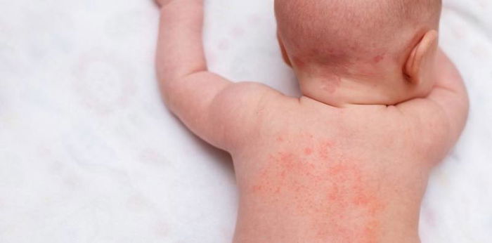 Begini Cara Mengatasi 3 Jenis Biang Keringat pada Bayi