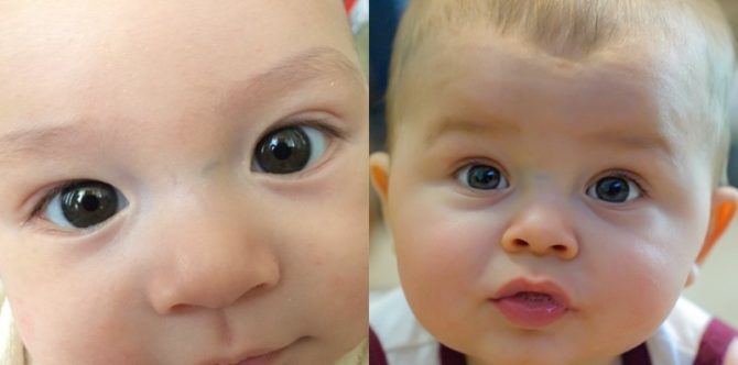 Muncul garis biru di antara hidung dan kedua mata bayi, benarkah tanda ADHD?