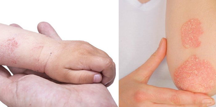 8 Penyebab kulit mengelupas dan gatal, kenali cara mengatasinya berikut ini!