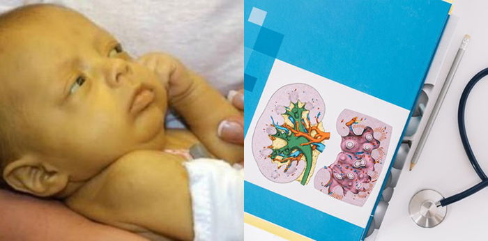 Berapa Kadar Normal Bilirubin pada Bayi? Begini Cara Mengeceknya, Parents