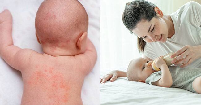 Ciri-Ciri Bayi Alergi Susu Sapi yang Harus Bunda Ketahui