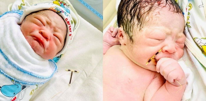 Viral! Bayi Ini Lahir Sambil Pegang Alat Kontrasepsi IUD Ibunya