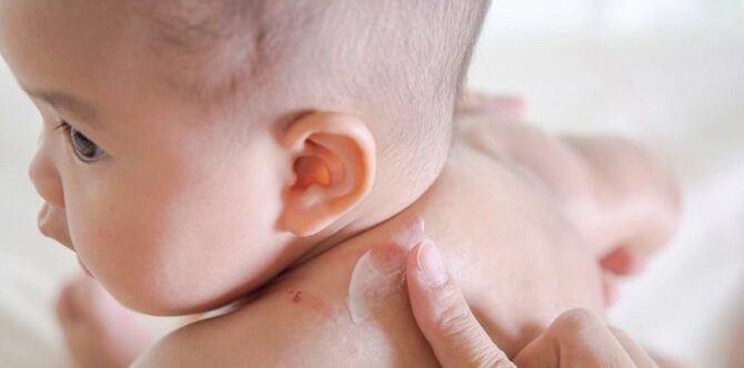 Ketahui Penyebab 16 Bintik Merah pada Bayi dan Cara Mengatasinya