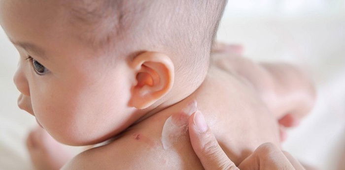 Ketahui Penyebab 16 Bintik Merah pada Bayi dan Cara Mengatasinya
