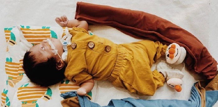 Mengenal Moebius Syndrome, Kondisi Langka yang Sebabkan Bayi Tak Bisa Berekspresi